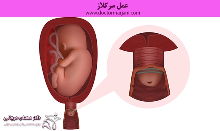 عمل سرکلاژ