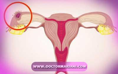 حاملگی خارج از رحم، از علل تا درمان