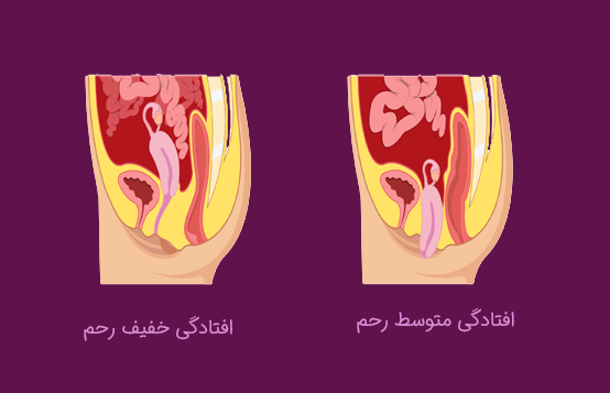انواع افتادگی رحم