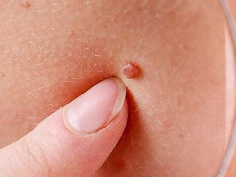 آیا بعد از درمان زگیل تناسلی میتوان باردار شد؟